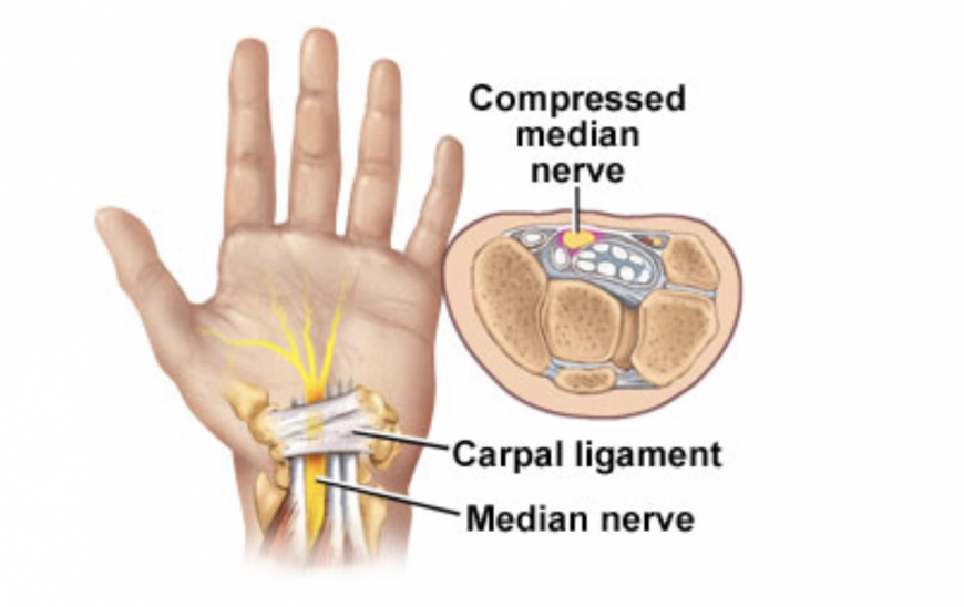 Carpal tunnel syndrome while pregnant in Dubai